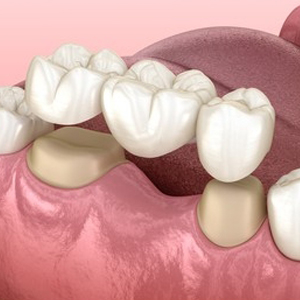 Dental Crowns and Bridges