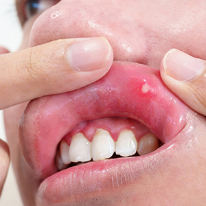 Mouth Ulcer